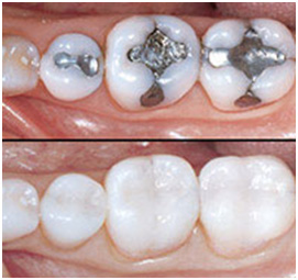 Amalgam Composite