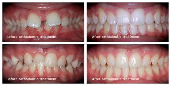 Before-After